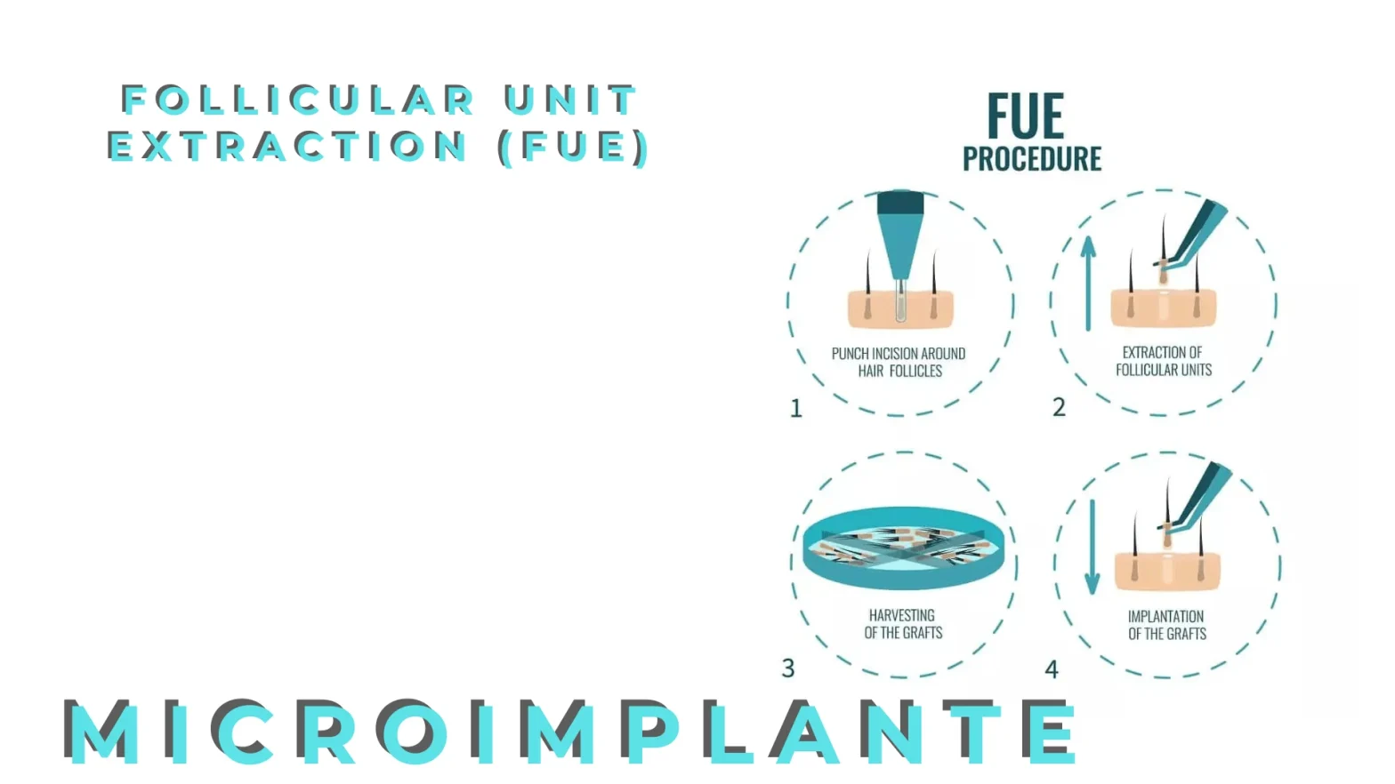 Nueva técnica de implante capilar 