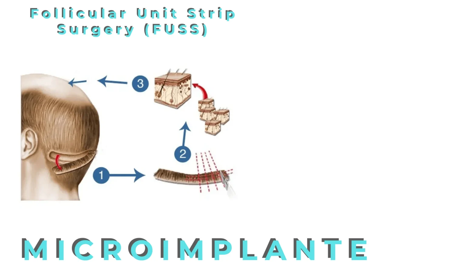 Micro implante capilar. Técnica FUSS 